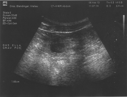 Ultraschall Ultraschall